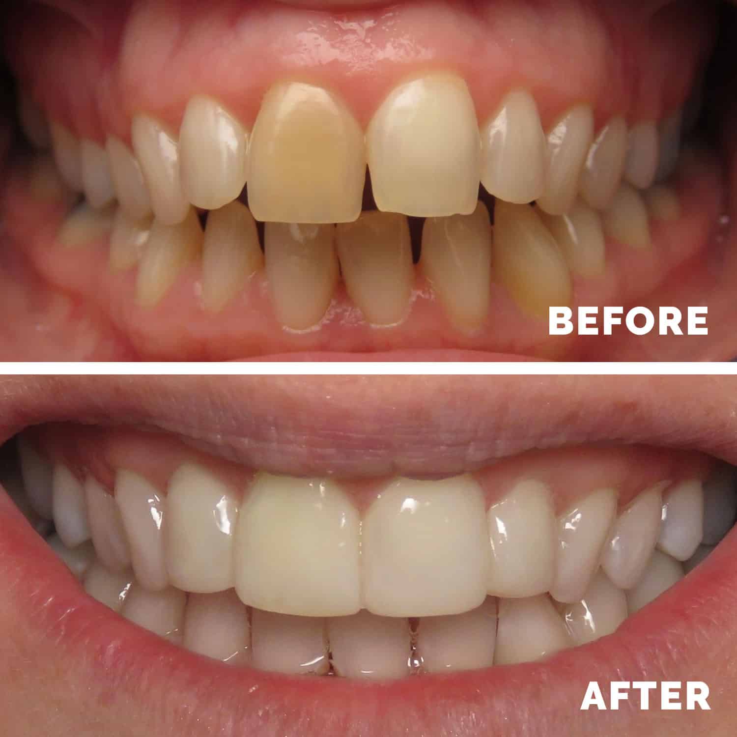 Tooth Whitening Liverpool